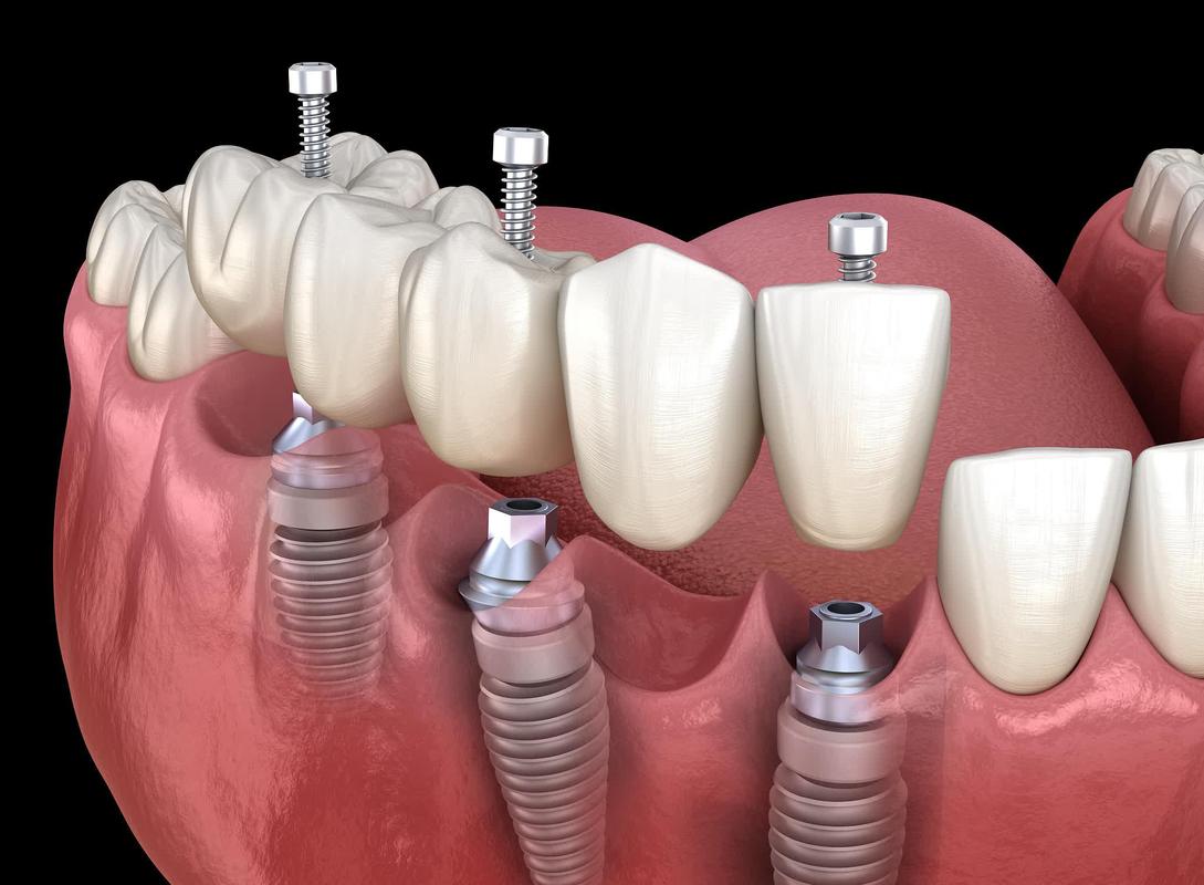 温江区种植牙口腔医院_温江博‮口恩‬腔诊所种植牙价格_种植口腔医院