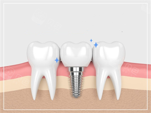 种植牙与真实牙齿漫画示意图